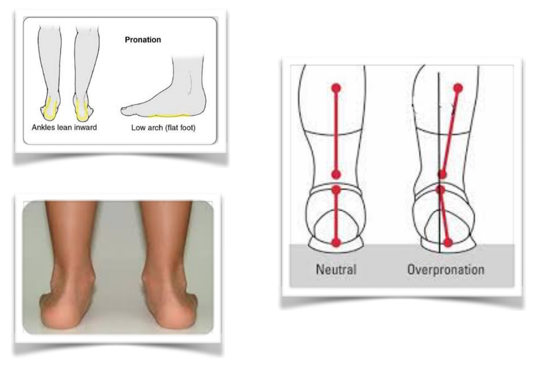 Foot Pronation - BDI Playhouse Children's Therapy
