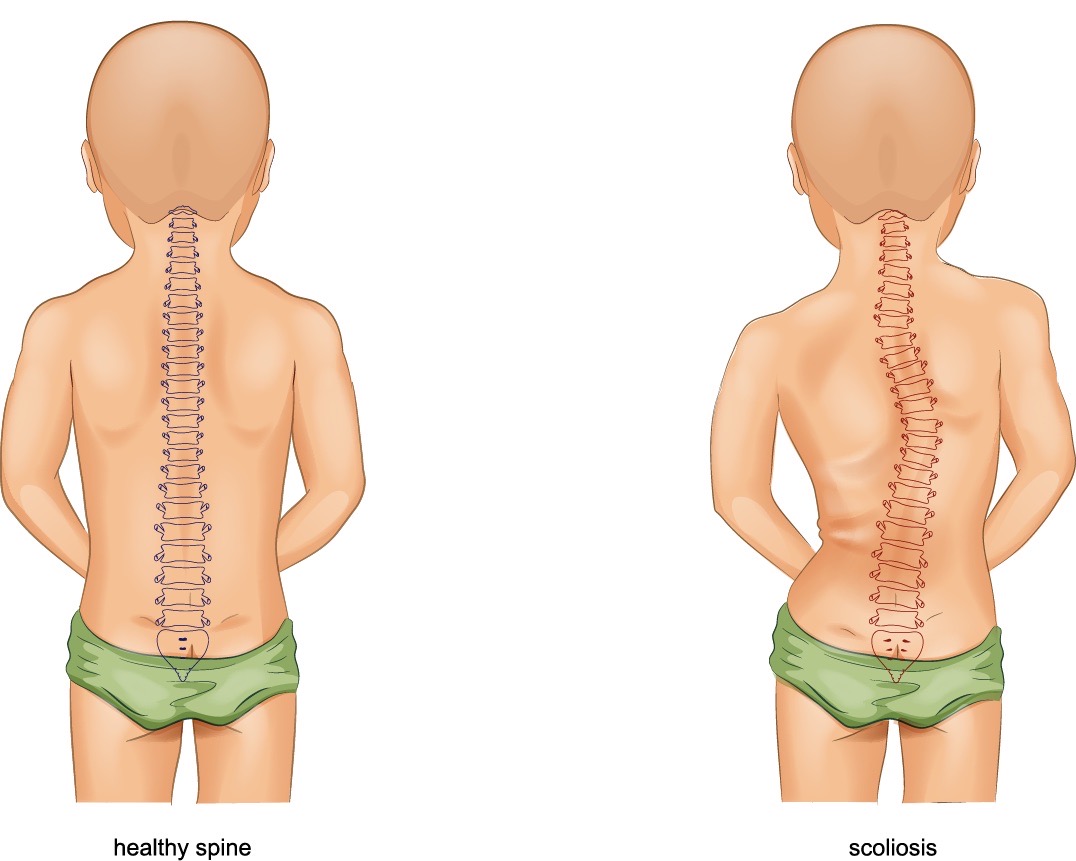 Scoliosis in childhood